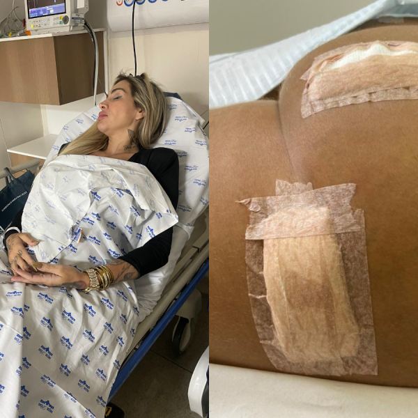 Influenciadora é internada às pressas devido infecção causada por hidrogel no bumbum