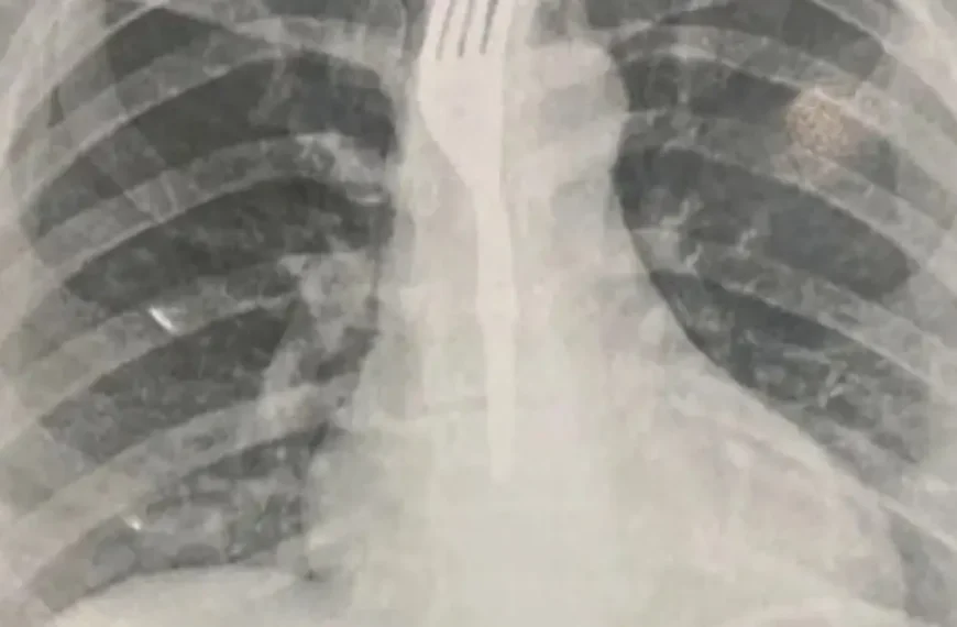 Com garfo no corpo, mulher é internada em hospital após engolir utensílio durante refeição na Bahia