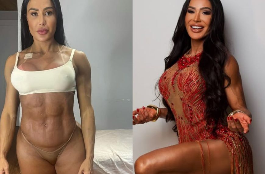 Gracyanne mostra antes e depois e explica ganho de 20 kg na balança após cirurgia