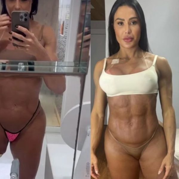 “Zero preocupada com estética”: Gracyanne surge com perna enfaixada após cirurgia