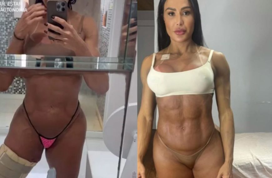 “Zero preocupada com estética”: Gracyanne surge com perna enfaixada após cirurgia