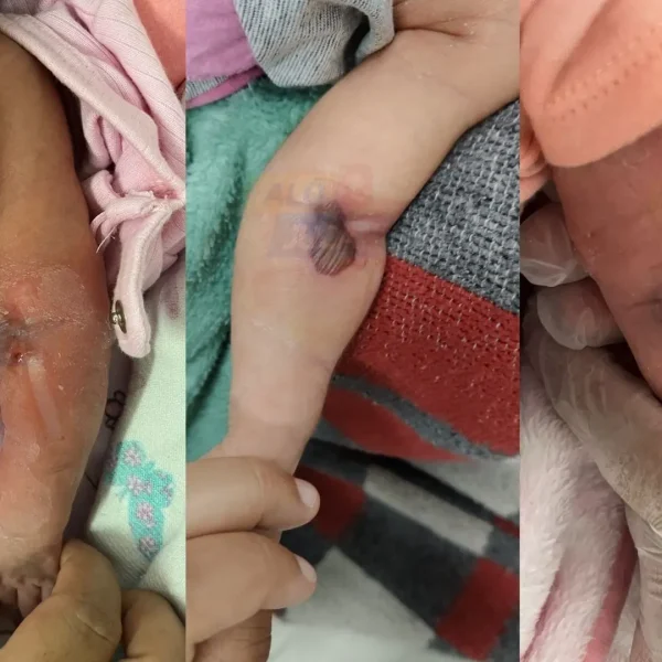 Recém-nascida sofre grave lesão após suposto erro médico em hospital de Itaparica