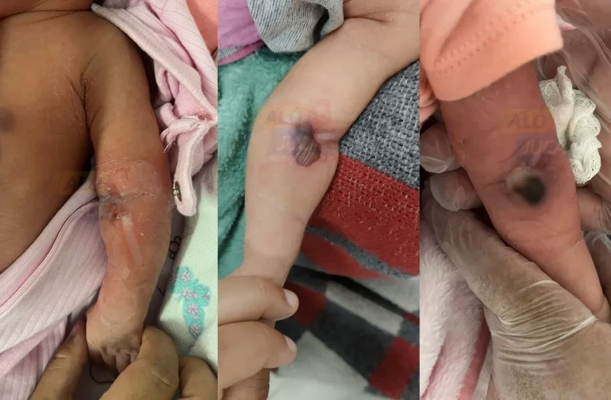 Recém-nascida sofre grave lesão após suposto erro médico em hospital de Itaparica