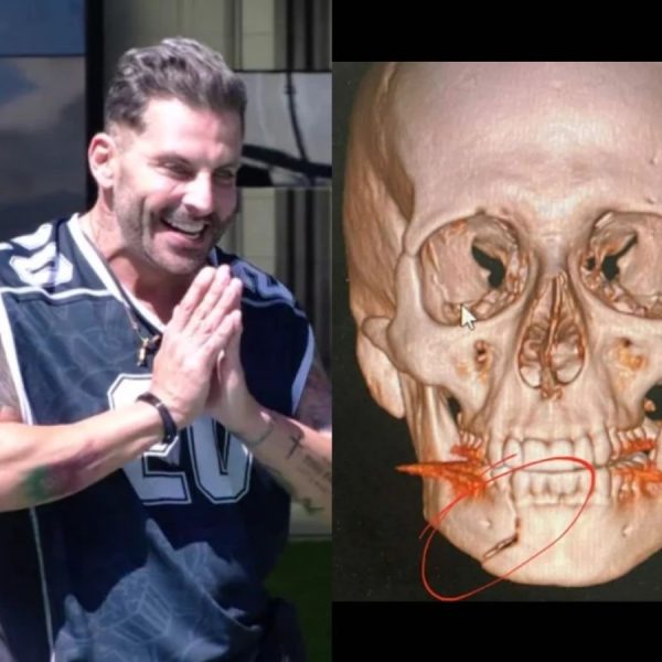 Mandíbula fraturada e sequelas: o drama de saúde que Henri Castelli carrega até hoje