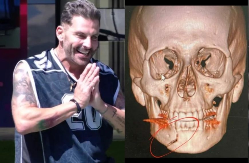 Mandíbula fraturada e sequelas: o drama de saúde que Henri Castelli carrega até hoje